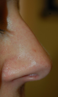 Spider angioma after IPL treatment